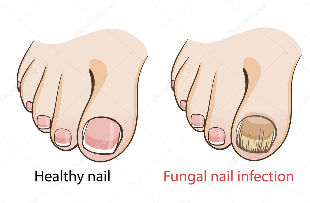 Nail fungal infection Medical poster