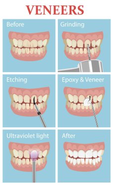 Veneers Vektör tıbbi poster
