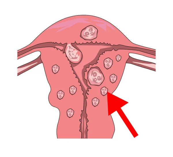 Fibromas uterinos. con un puntero al mioma y puntos de dolor . Vectores de stock libres de derechos