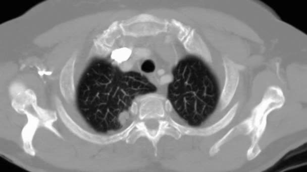 黒い背景に肺癌のアニメーション — ストック動画