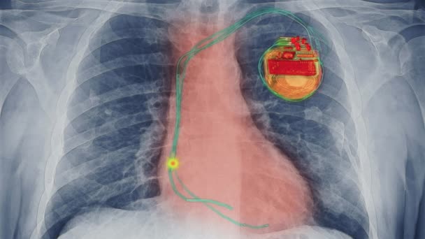 Datoranimation Pacemaker Bränning — Stockvideo