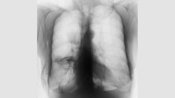 Radiografia Mostrando Tórax Com Câncer Pulmão — Vídeo de Stock