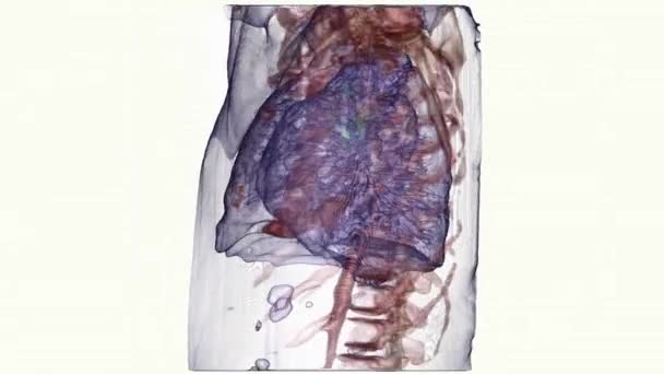 白い背景の肺癌のグラフィックの復興 — ストック動画