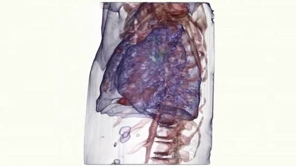 Reconstrucción Gráfica Del Cáncer Pulmón Sobre Fondo Blanco — Vídeos de Stock