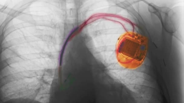 Animação Por Computador Pacemaker — Vídeo de Stock