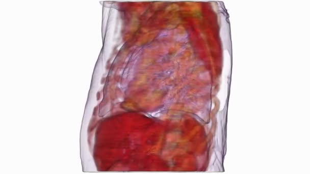 白い背景の肺癌のグラフィックの復興 — ストック動画