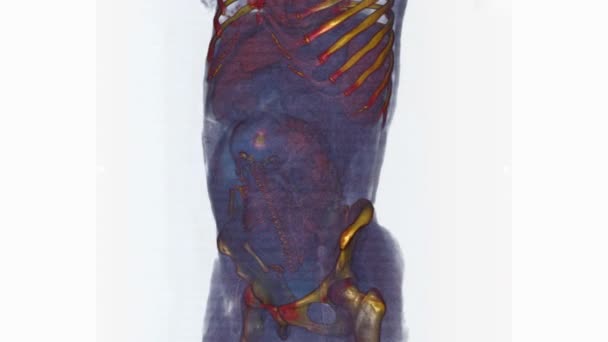 胎儿子宫内隆起部位的猫扫描 — 图库视频影像