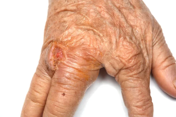 Hand Old Woman Shows Wrinkles Wounds Grandmother Fell Received Deep — Stock Photo, Image