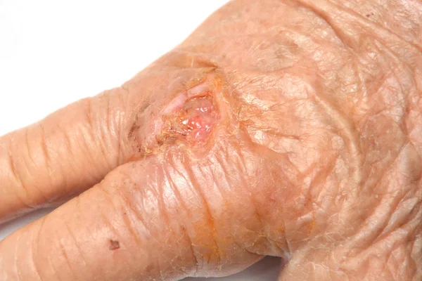 Mão Velha Mostra Rugas Feridas Avó Caiu Recebeu Uma Ferida — Fotografia de Stock