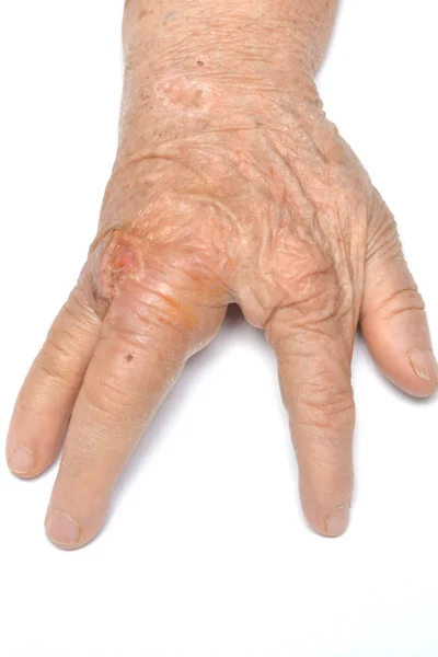 Die Hand Der Alten Frau Zeigt Falten Und Wunden Die — Stockfoto