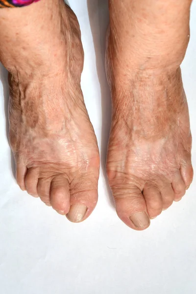 Die Füße Der Seniorin Stehen Auf Poliertem Stein Nahaufnahme Körperkonzept — Stockfoto