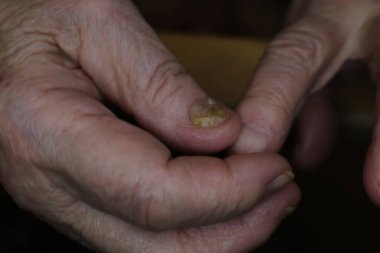 Yaşlı bir büyükannenin kanseriyle ilgili tıbbi hazırlıklar