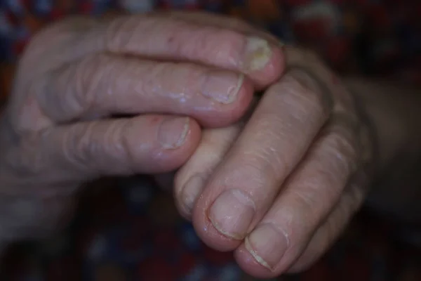 Preparazioni Mediche Tumori Una Nonna Vecchia — Foto Stock