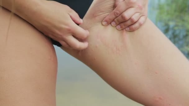 Picazón, reacción alérgica en las niñas de la cadera — Vídeo de stock
