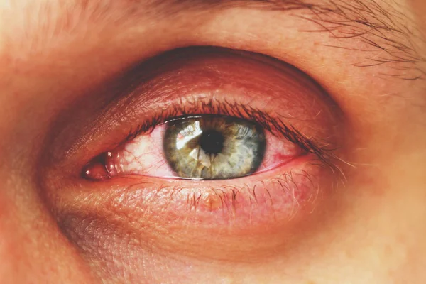 Occhio Rosso Paziente Con Congiuntivite Umana Tonica Retrò — Foto Stock
