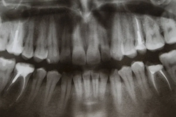 Att Studera Röntgen Tänder — Stockfoto
