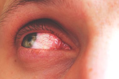 kırmızı göz tonda olan insan konjonktivit, retro bir hastanın