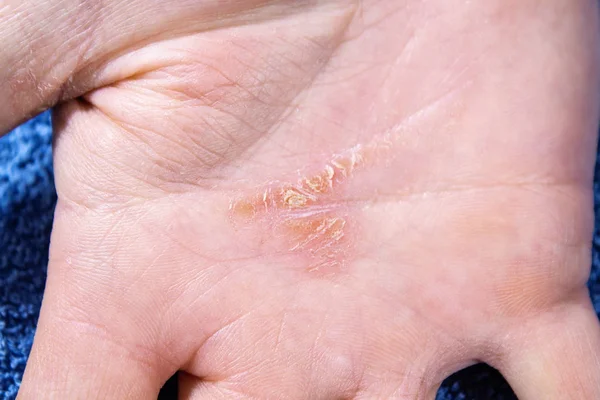 Piel Quebrada Escamosa Palma Mano Problemas Dermatológicos Psoriasis —  Fotos de Stock