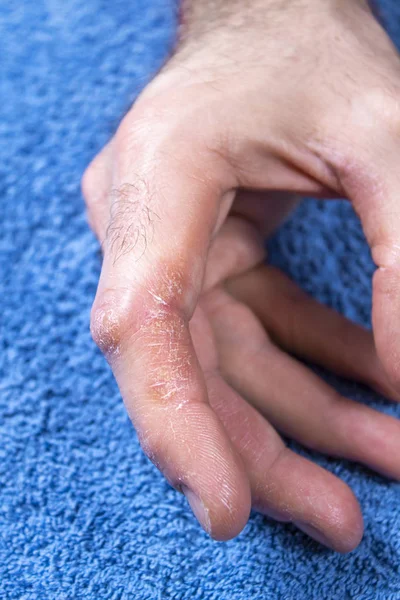 Pelle Dura Arrapata Screpolata Dito Nella Mano Uomo Psoriasi Allergia — Foto Stock