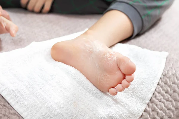 Детская Кожная Болезнь Белая Пыль Лежит Ноге Ребенка — стоковое фото