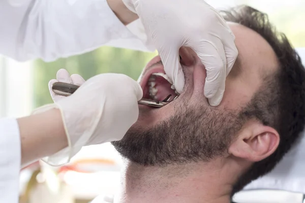 Tooth extraction in a white man. The doctor's hands hold the forceps and catch the tooth.