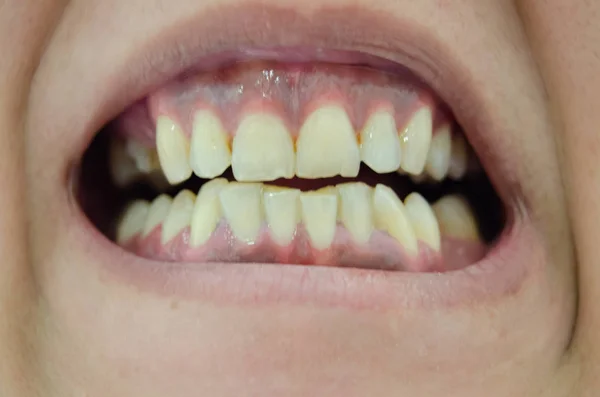 Persona mostrando dientes rotos y amarillos muy feos — Foto de Stock