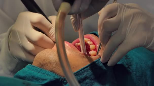 Tratamiento Odontológico Profesional Limpieza Dientes Placa Procedimientos Odontología — Vídeo de stock