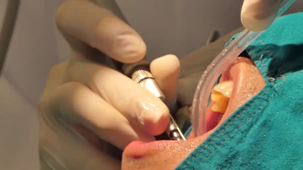 Tratamento Odontológico Profissional Limpeza Dentes Placa Procedimentos Odontologia — Vídeo de Stock