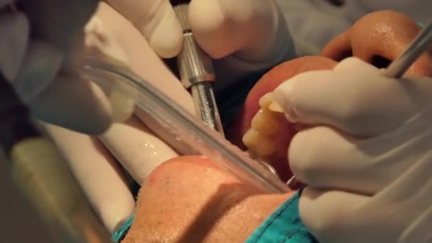 Tratamento Odontológico Profissional Limpeza Dentes Placa Procedimentos Odontologia — Vídeo de Stock