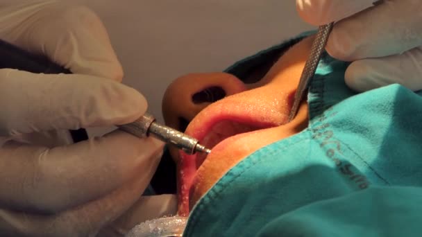 Professionelle Zahnärztliche Behandlung Und Reinigung Der Zähne Von Plaque Oder — Stockvideo