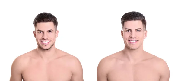 Schöner Junger Mann Vor Und Nach Der Rasur Auf Weißem — Stockfoto