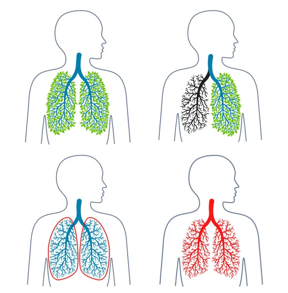 Conjunto de ilustraciones de la temática del sistema respiratorio.Tuberculosis.Tuberculosis. Enfermedad pulmonar. Cáncer de pulmón. Promoción de estilos de vida saludables. Medicina, salud y ecología. ilustraciones vectoriales . — Archivo Imágenes Vectoriales