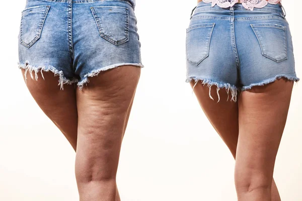 セルライトの有無にかかわらず女性の足太ももの比較 皮膚の問題 ボディケア 太りすぎと食事の概念 — ストック写真