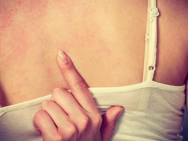 Health Problem Skin Diseases Young Woman Showing Her Itchy Back — Stock Photo, Image