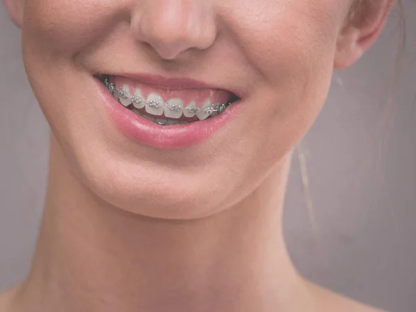 Concepto Dentista Ortodoncista Primer Plano Sonrisa Mujer Mostrando Los Dientes — Foto de Stock