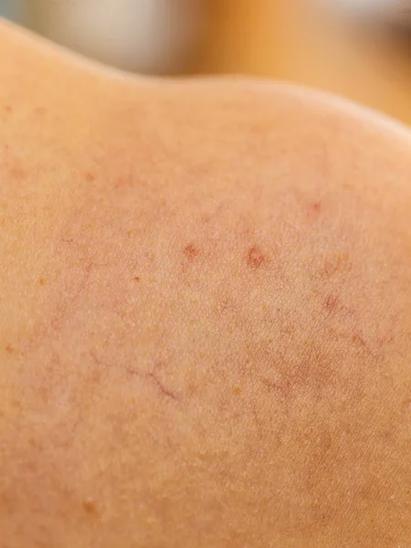 Pessoa Com Dermatoses Pele Conceito Problemas Cuidados Com Pele Close — Fotografia de Stock