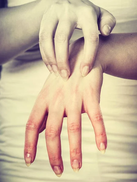 Дерматология Аллергия Проблемы Здоровьем Молодая Женщина Чешет Свою Зудящую Ладонь — стоковое фото