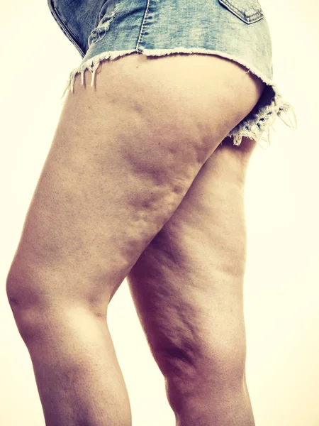 Женские Ноги Бедра Проблемой Целлюлита Кожи Уход Телом Избыточный Вес — стоковое фото