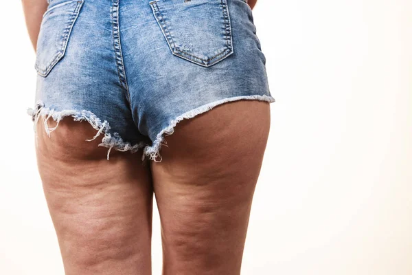 Donna Gambe Cosce Con Problemi Pelle Cellulite Cura Del Corpo — Foto Stock