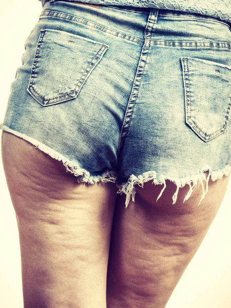 Γυναίκα Πόδια Τους Μηρούς Πρόβλημα Cellulite Δέρματος Φροντίδα Υπερβολικό Βάρος — Φωτογραφία Αρχείου