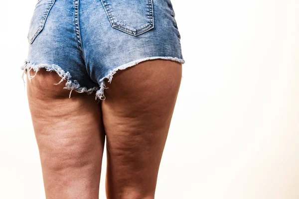 Vrouw Benen Dijen Met Cellulitis Huid Probleem Lichaam Verzorging Overgewicht — Stockfoto