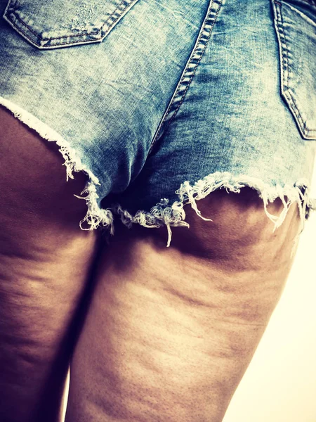 Женские Ноги Бедра Проблемой Целлюлита Кожи Уход Телом Избыточный Вес — стоковое фото
