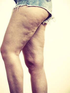 Selülit cilt sorunu ile kadın bacağı uyluk. Vücut Bakımı, şişmanlık ve diyet kavramı.