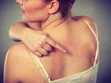 Sağlık sorunları, deri hastalıkları. Sırtındaki kaşıntıyı alerji kaynaklı ürtiker belirtileriyle gösteren genç bir kadın.