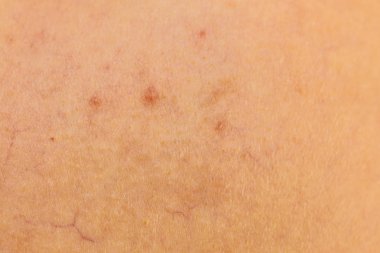 Kişi dermatozlar derisinin üzerinde olan. Cilt sorunları kavramı. Genişlemiş kılcal damarlar, varis, kırmızı diken diken yakın çekim.