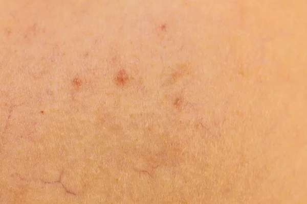 그녀의 피부에 Dermatoses를가지고 사람입니다 스킨케어 개념입니다 클로즈업 — 스톡 사진