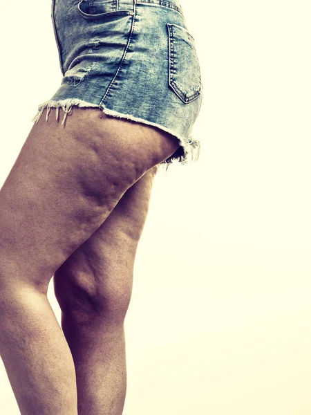 Žena Nohy Stehna Celulitidou Kožní Problém Koncept Péče Nadváha Diety — Stock fotografie