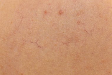 Kişi dermatozlar derisinin üzerinde olan. Cilt sorunları kavramı. Genişlemiş kılcal damarlar, varis, kırmızı diken diken yakın çekim.