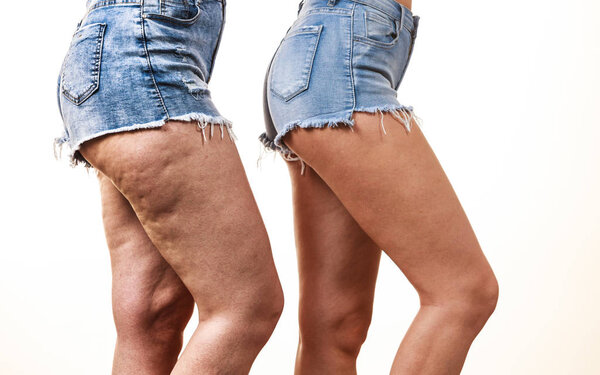 Comparison of female legs thighs with and without cellulite. Skin problem, body care, overweight and dieting concept.