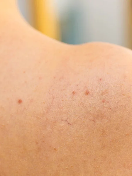 Persona Que Tiene Dermatosis Piel Concepto Problemas Cuidado Piel Primer — Foto de Stock